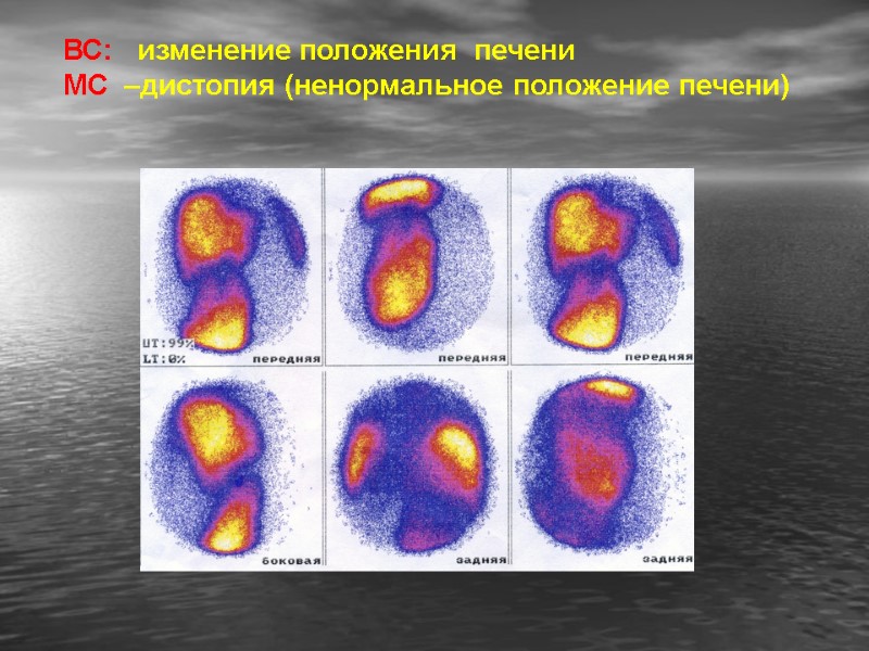 ВС:   изменение положения  печени МС  –дистопия (ненормальное положение печени)